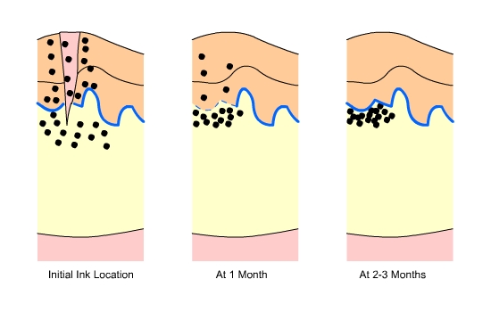 Các giai đoạn phân tán của mực lên da